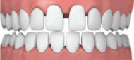 wide spaced teeth