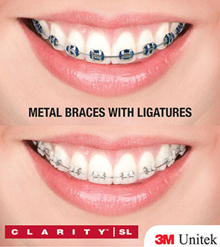 metal vs clear braces