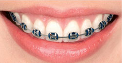 conventional braces