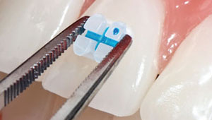 thailand clear braces