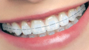 3M clarity braces
