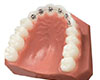 hidden braces
