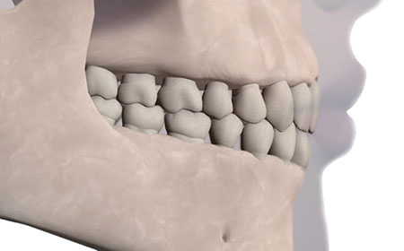 jaw occlusions