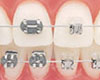 damon braces